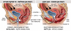 תרגיל קיגל נכון — כיווץ קדימה פנימה ולמעלה, מול דחיפה כלפי