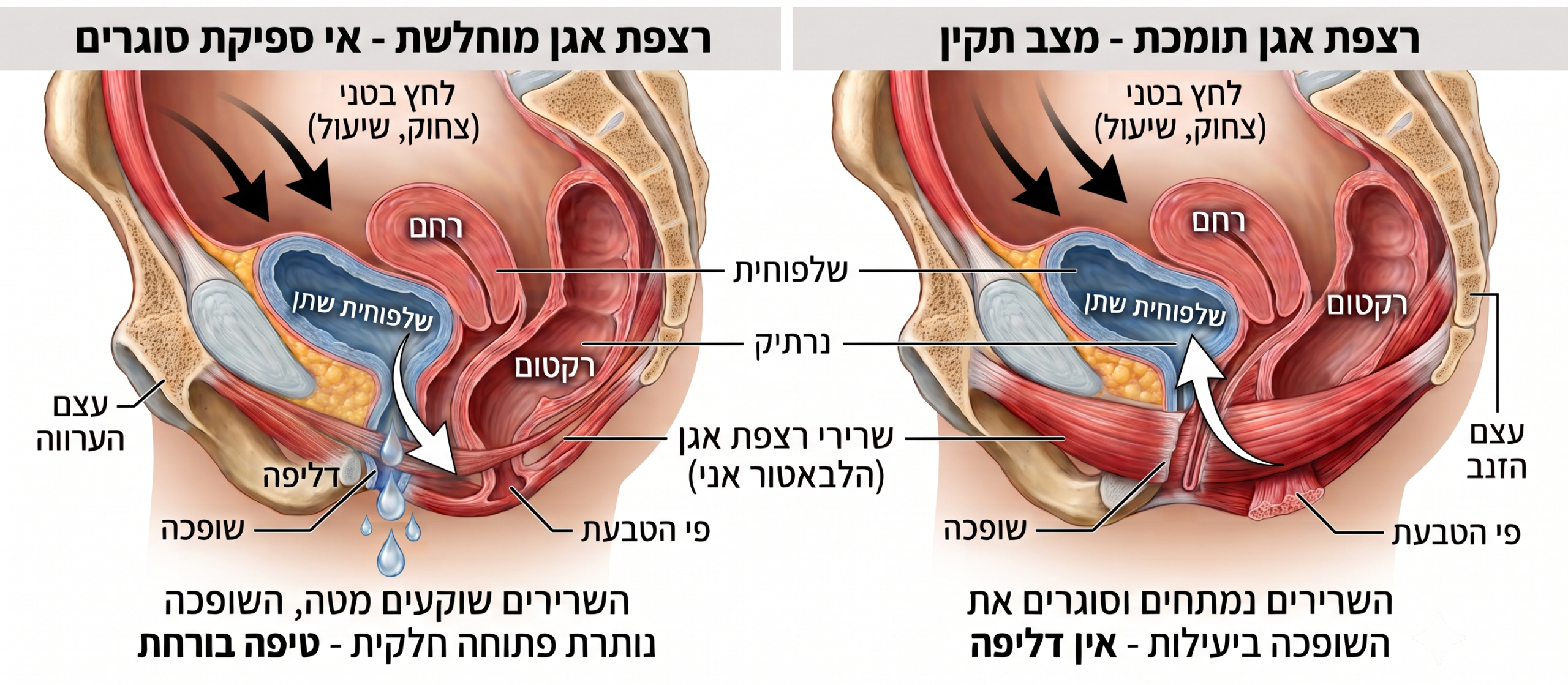 מנגנון דליפת שתן במאמץ — רצפת אגן תומכת(מימין) מול מוחלשת(משמאל).