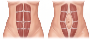 הפרדות שרירי בטן (Diastasis Recti Abdominis)